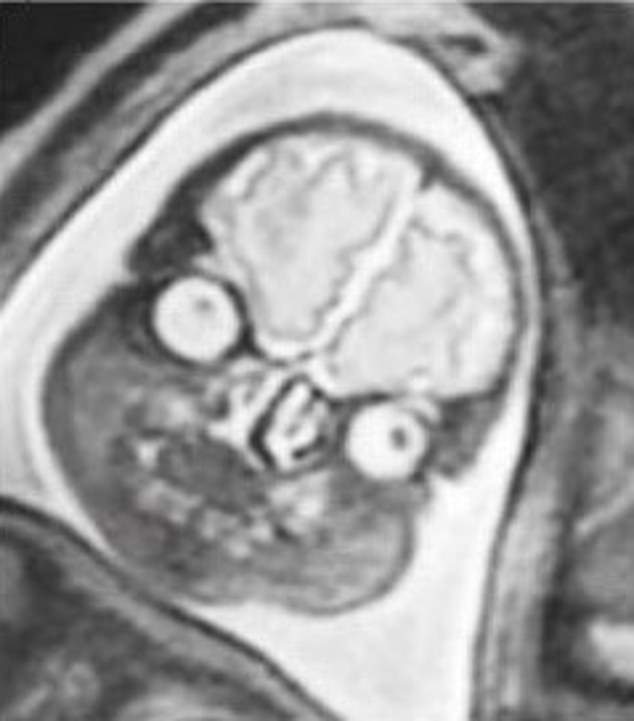 MRI images of babies tend not to get the same social media attention as ultrasound images as the very detailed images can look a little on the demonic side, according to hundreds of social media users